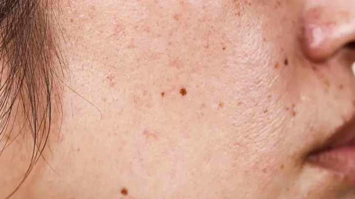 Why are my pores so big?